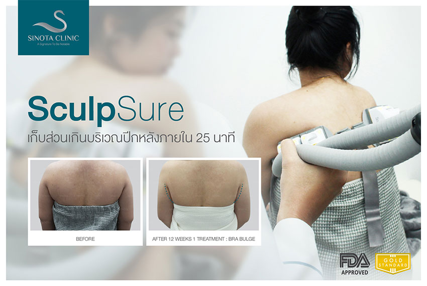 สลายไขมัน sculpsure
