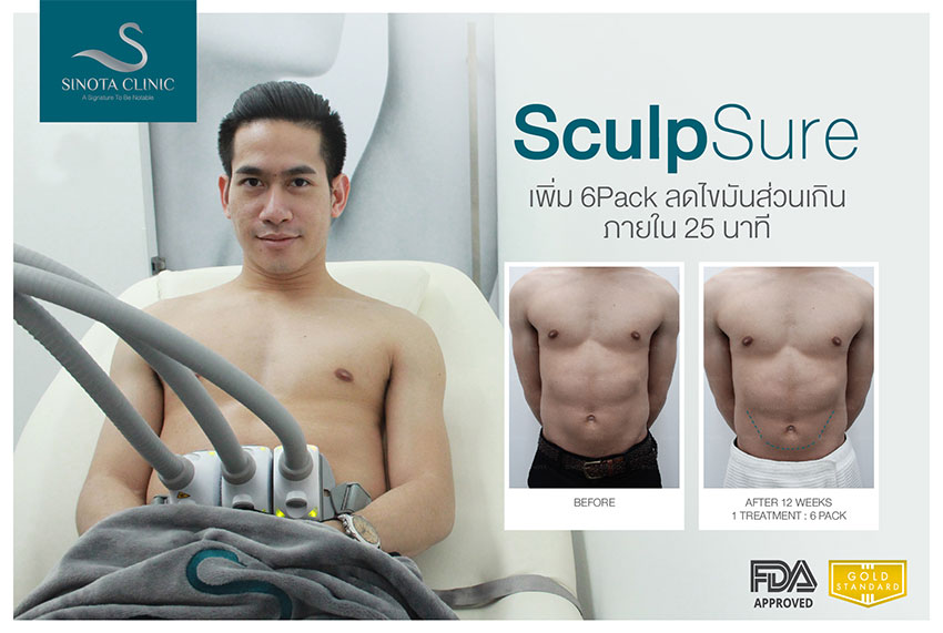 สลายไขมัน sculpsure