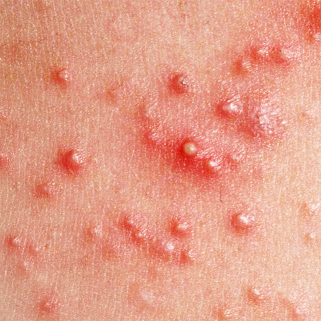 อายุเยอะแล้วไม่ใช่วัยใสแต่ทำไมยังเป็นสิว