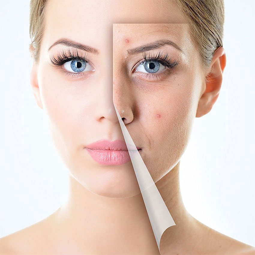 อายุเยอะแล้วทำไมยังเป็นสิวน่าแปลกไหม