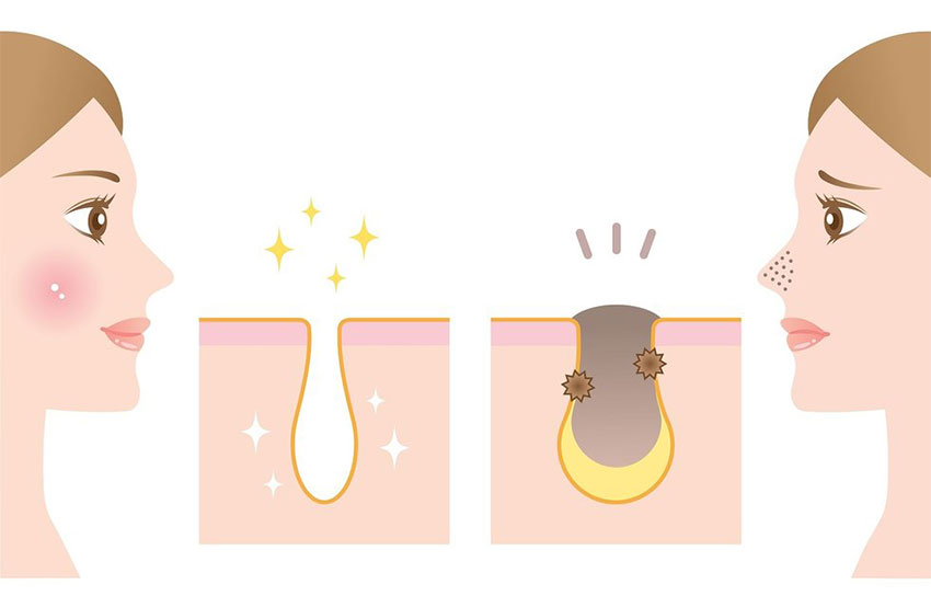 รูขุมขนกว้างทำอย่างไรด