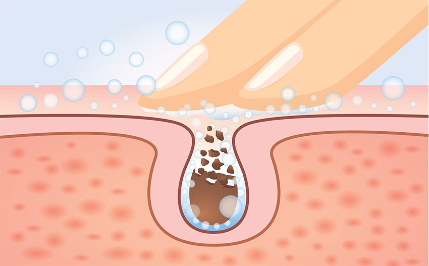 รูขุมขนกว้างทำอย่างไรด