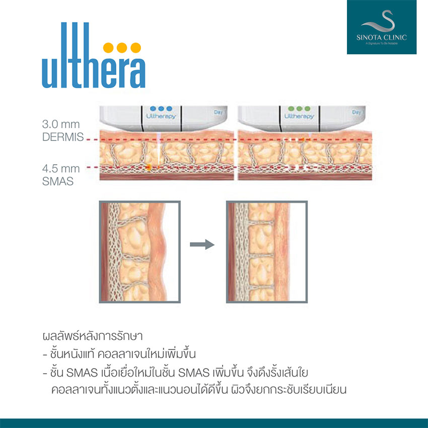 Ulthera บุฟเฟ่ต์ไม่จำกัดช็อตไม่มีจริง