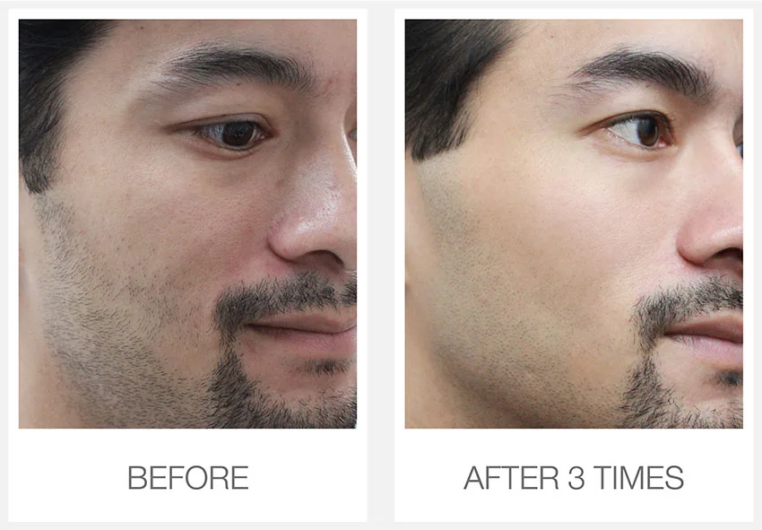 รูขุมขนกว้าง ทำยังไงให้เล็กลง? ศัลยแพทย์ใช้เทคนิค Pore Refining Laser