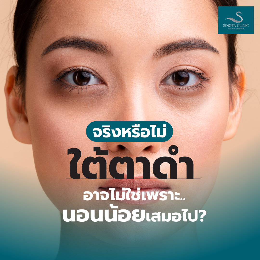 จริงหรือไม่ ใต้ตาดำ อาจไม่ใช่เพราะนอนน้อยเสมอไป - Sinota Clinic